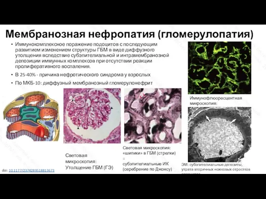Мембранозная нефропатия (гломерулопатия) Иммунокомплексное поражение подоцитов с последующим развитием изменением структуры ГБМ