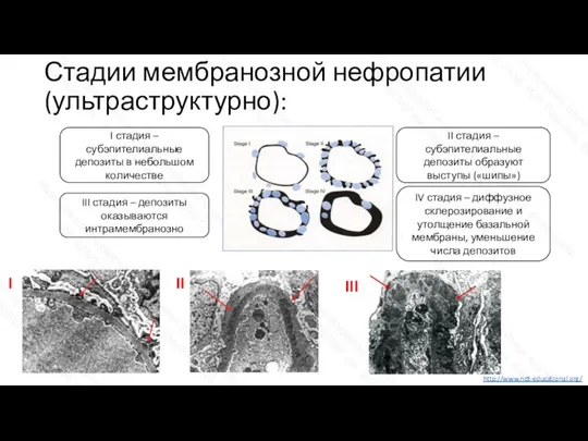 Стадии мембранозной нефропатии (ультраструктурно): I стадия – субэпителиальные депозиты в небольшом количестве