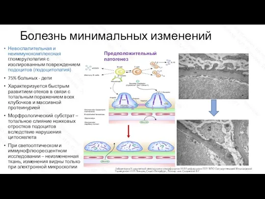 Болезнь минимальных изменений Невоспалительная и неиммунокомплексная гломерулопатия с изолированным повреждением подоцитов (подоцитопатия)