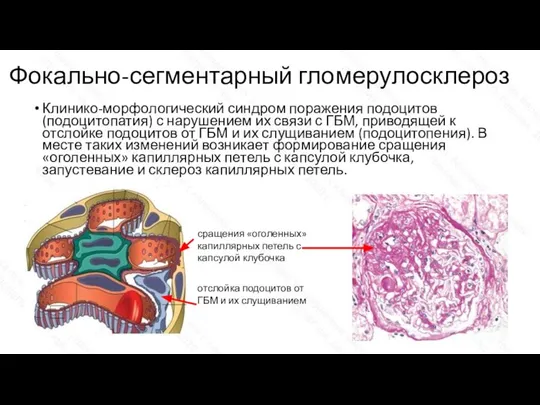Фокально-сегментарный гломерулосклероз Клинико-морфологический синдром поражения подоцитов (подоцитопатия) с нарушением их связи с