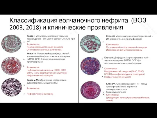 Классификация волчаночного нефрита (ВОЗ 2003, 2018) и клинические проявления Класс I. Минимальные