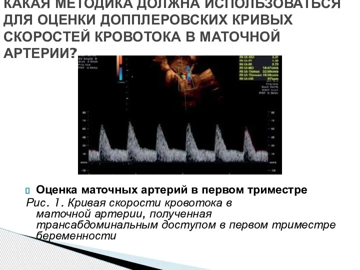 Оценка маточных артерий в первом триместре Рис. 1. Кривая скорости кровотока в