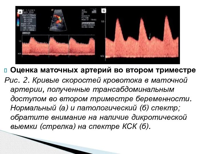 Оценка маточных артерий во втором триместре Рис. 2. Кривые скоростей кровотока в