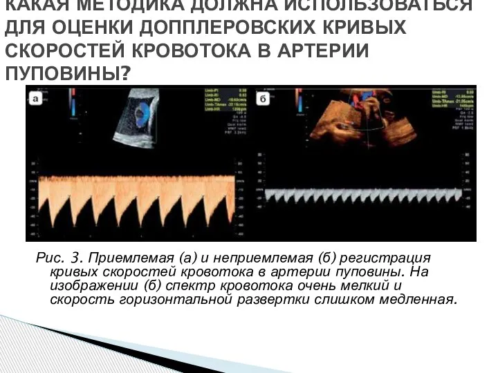 Рис. 3. Приемлемая (а) и неприемлемая (б) регистрация кривых скоростей кровотока в