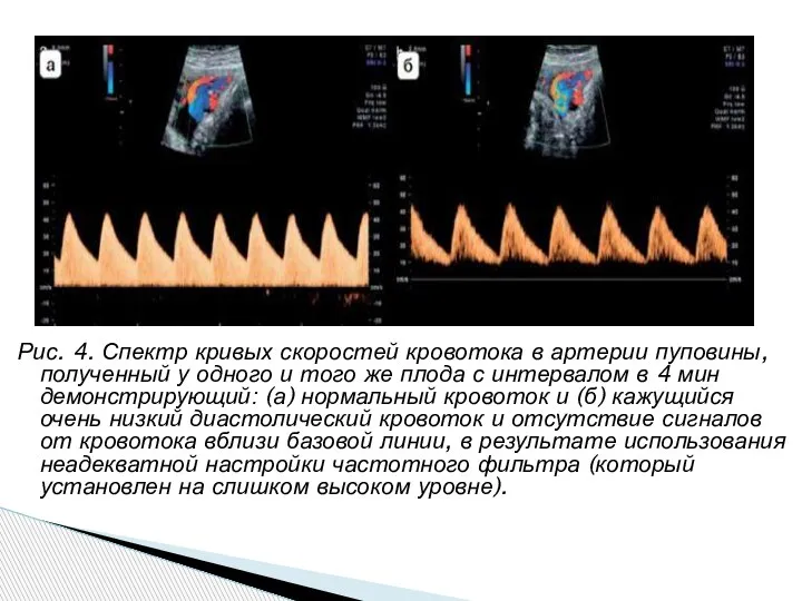 Рис. 4. Спектр кривых скоростей кровотока в артерии пуповины, полученный у одного