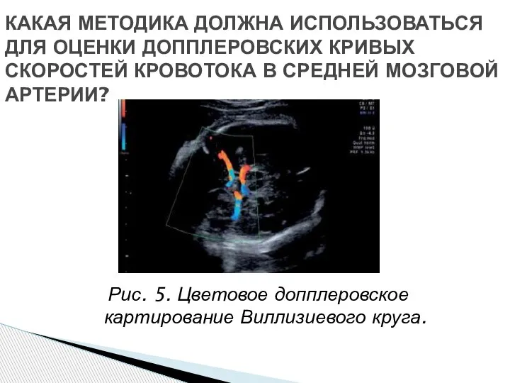 Рис. 5. Цветовое допплеровское картирование Виллизиевого круга. КАКАЯ МЕТОДИКА ДОЛЖНА ИСПОЛЬЗОВАТЬСЯ ДЛЯ