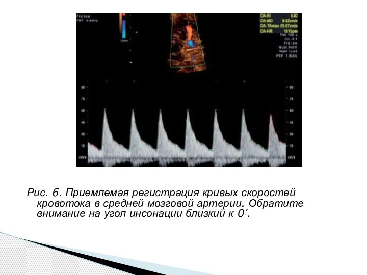 Рис. 6. Приемлемая регистрация кривых скоростей кровотока в средней мозговой артерии. Обратите