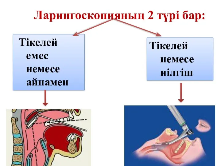 Ларингоскопияның 2 түрі бар: Тікелей емес немесе айнамен Тікелей немесе иілгіш