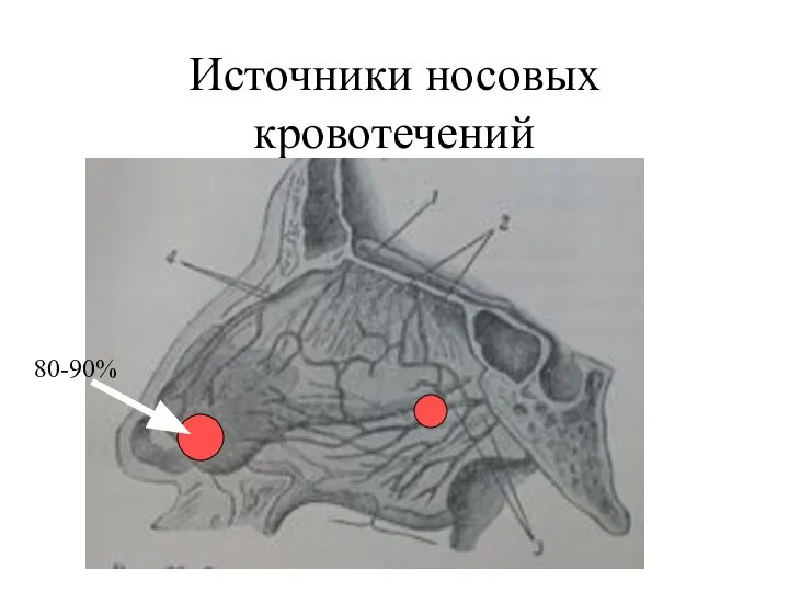 Источники носовых кровотечений 80-90%