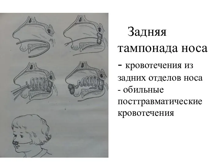 Задняя тампонада носа - кровотечения из задних отделов носа - обильные посттравматические кровотечения