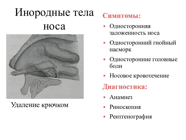 Инородные тела носа Удаление крючком Симптомы: Односторонняя заложенность носа Односторонний гнойный насморк