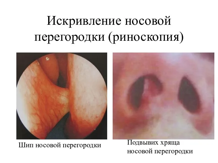 Искривление носовой перегородки (риноскопия) Подвывих хряща носовой перегородки Шип носовой перегородки