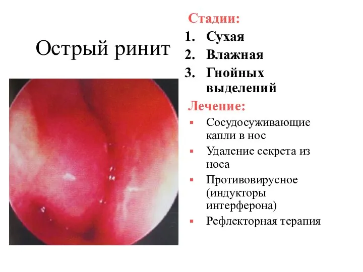 Острый ринит Стадии: Сухая Влажная Гнойных выделений Лечение: Сосудосуживающие капли в нос