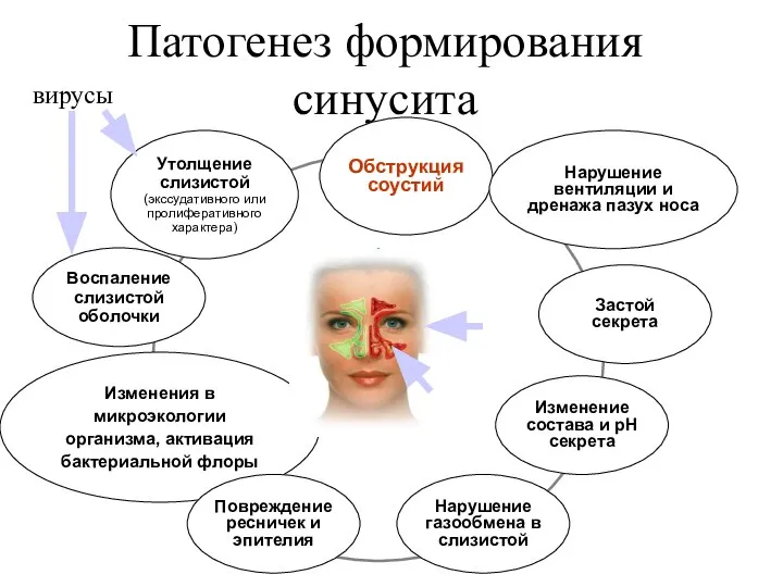 Патогенез формирования синусита Утолщение слизистой (экссудативного или пролиферативного характера) Обструкция соустий Изменение