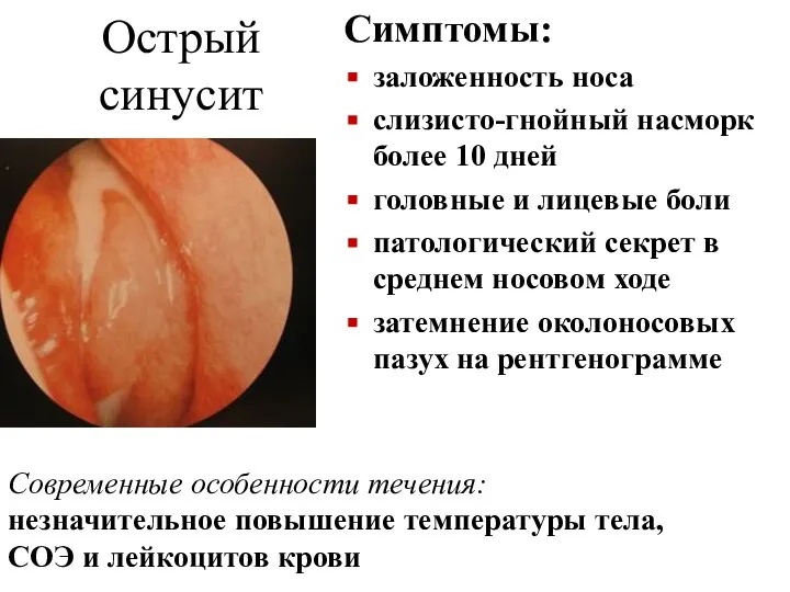 Острый синусит Симптомы: заложенность носа слизисто-гнойный насморк более 10 дней головные и