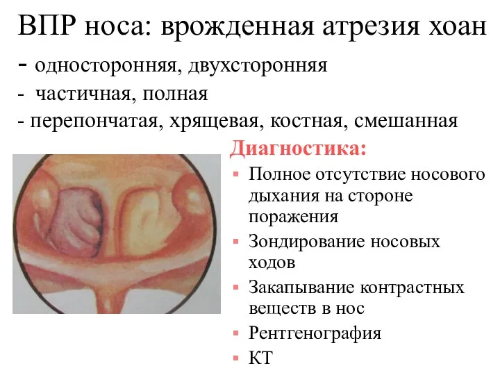 ВПР носа: врожденная атрезия хоан - односторонняя, двухсторонняя - частичная, полная -