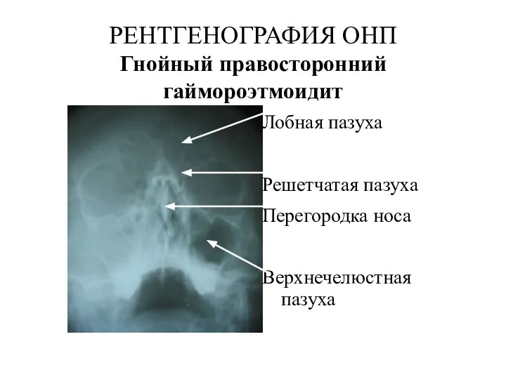 РЕНТГЕНОГРАФИЯ ОНП Гнойный правосторонний гаймороэтмоидит Лобная пазуха Решетчатая пазуха Перегородка носа Верхнечелюстная пазуха