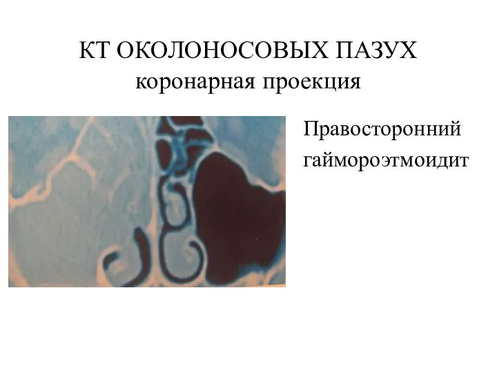 КТ ОКОЛОНОСОВЫХ ПАЗУХ коронарная проекция Правосторонний гаймороэтмоидит