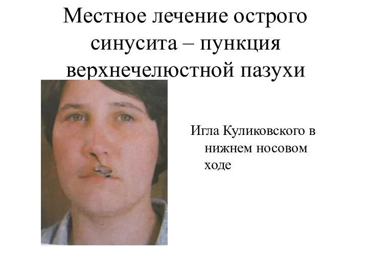 Местное лечение острого синусита – пункция верхнечелюстной пазухи Игла Куликовского в нижнем носовом ходе