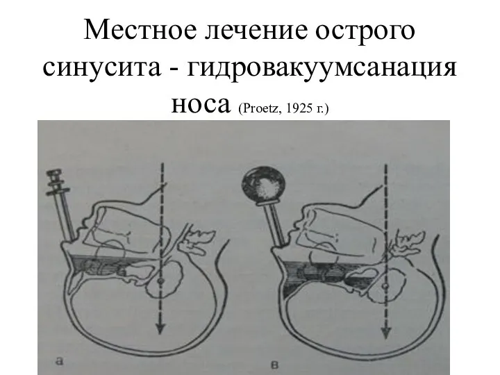 Местное лечение острого синусита - гидровакуумсанация носа (Proetz, 1925 г.)