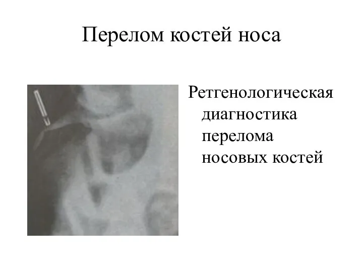 Перелом костей носа Ретгенологическая диагностика перелома носовых костей