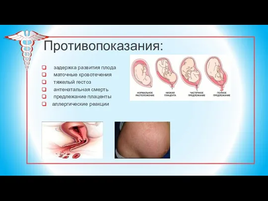 Противопоказания: задержка развития плода маточные кровотечения тяжелый гестоз антенатальная смерть предлежание плаценты аллергические реакции
