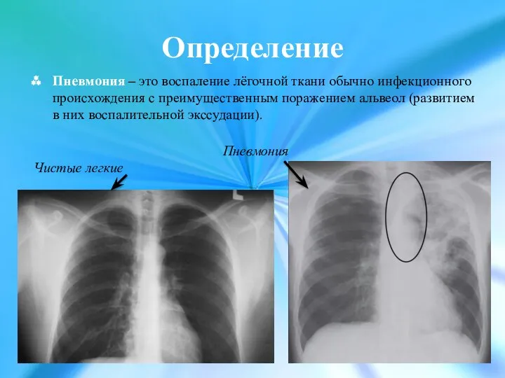 Определение Пневмония – это воспаление лёгочной ткани обычно инфекционного происхождения с преимущественным