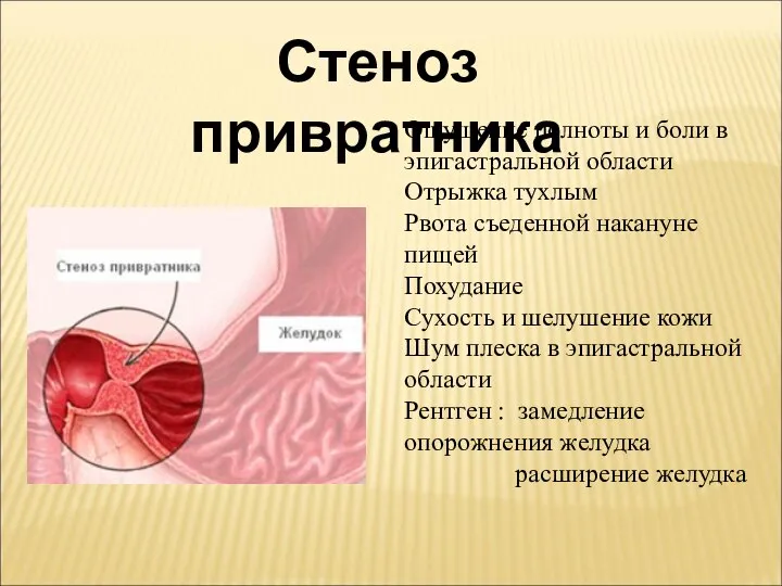 Стеноз привратника Ощущение полноты и боли в эпигастральной области Отрыжка тухлым Рвота