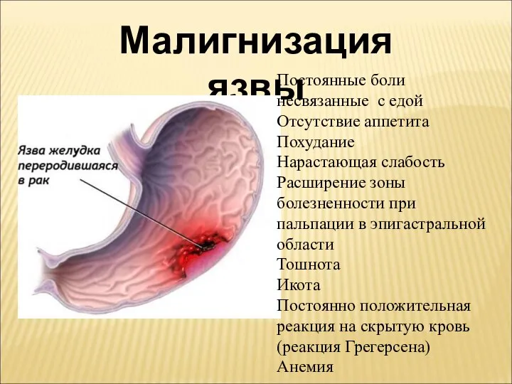 Малигнизация язвы Постоянные боли несвязанные с едой Отсутствие аппетита Похудание Нарастающая слабость