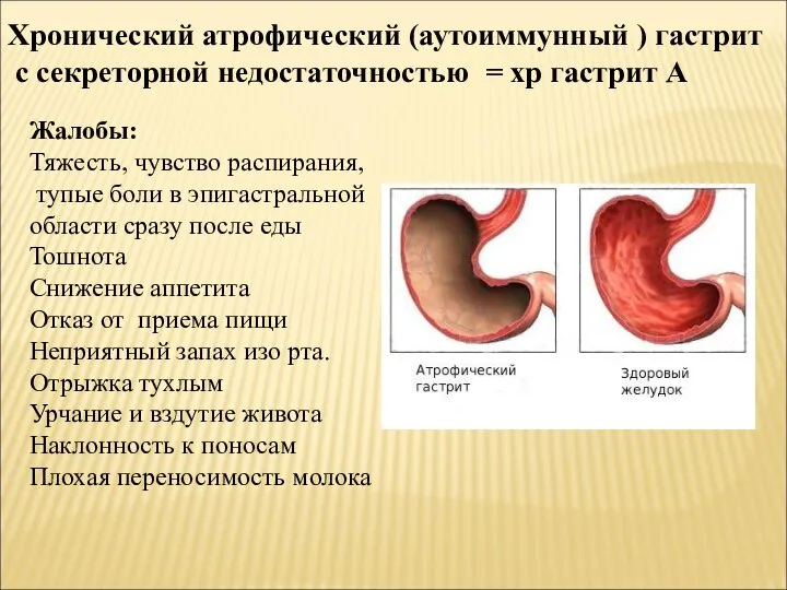 Хронический атрофический (аутоиммунный ) гастрит с секреторной недостаточностью = хр гастрит А