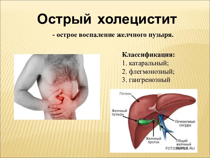 Острый холецистит - острое воспаление желчного пузыря. Классификация: 1. катаральный; 2. флегмонозный; 3. гангренозный