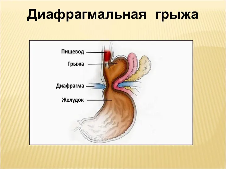 Диафрагмальная грыжа