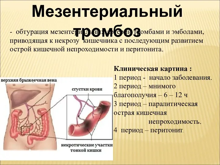 Мезентериальный тромбоз - обтурация мезентериальных артерий тромбами и эмболами, приводящая к некрозу