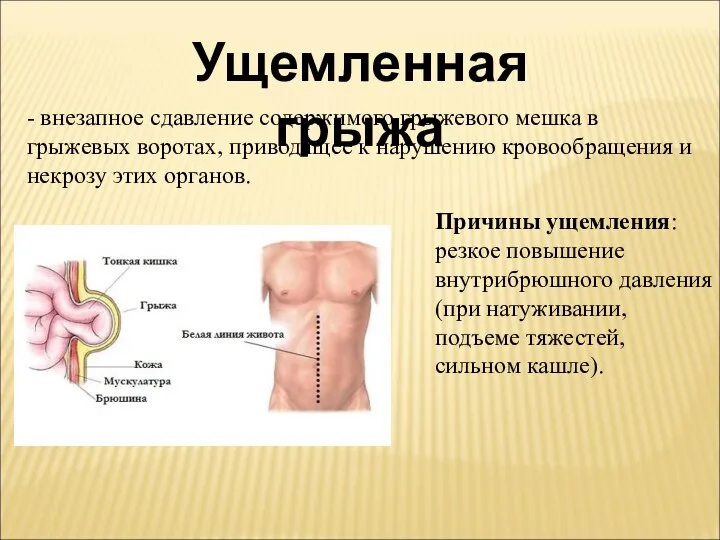 Ущемленная грыжа - внезапное сдавление содержимого грыжевого мешка в грыжевых воротах, приводящее