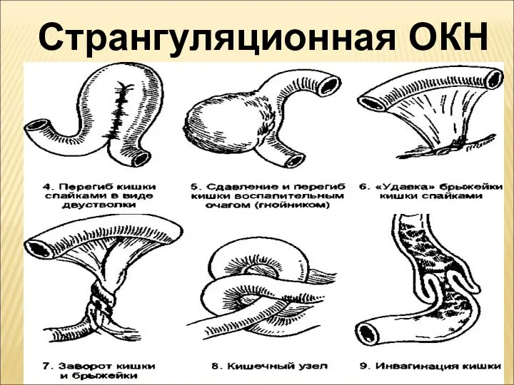 Странгуляционная ОКН