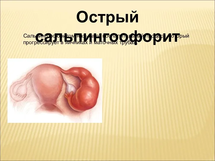 Острый сальпингоофорит Сальпингоофоритом называют воспалительный процесс, который прогрессирует в яичниках и маточных трубах.