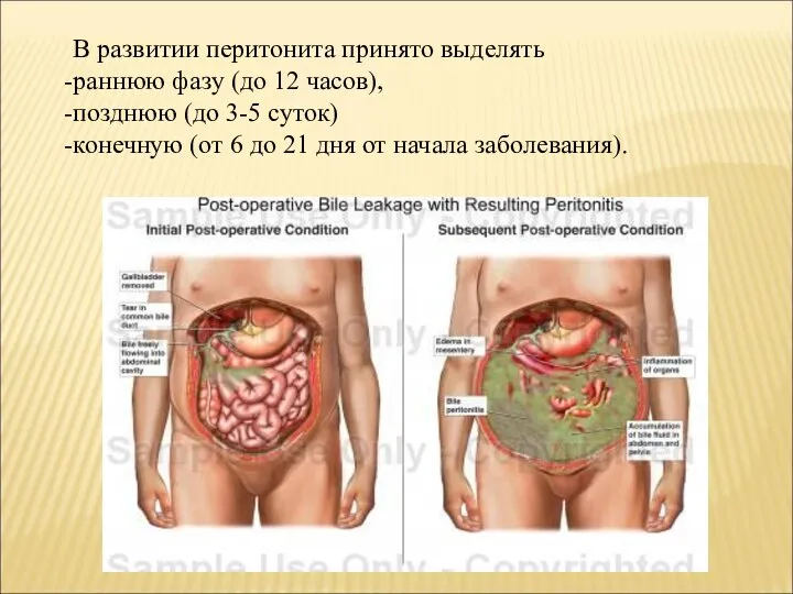 В развитии перитонита принято выделять раннюю фазу (до 12 часов), позднюю (до