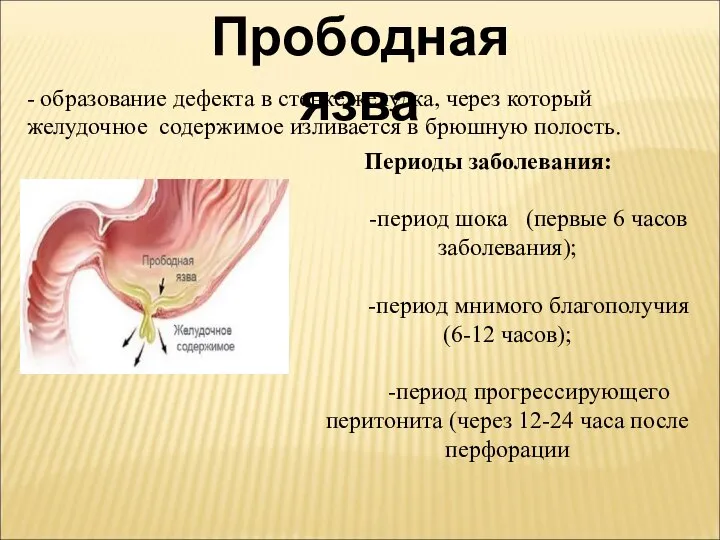 Прободная язва - образование дефекта в стенке желудка, через который желудочное содержимое