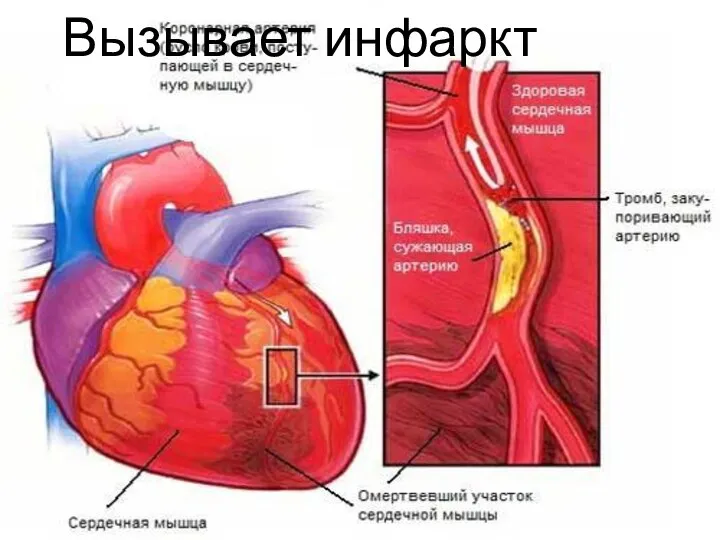 Вызывает инфаркт