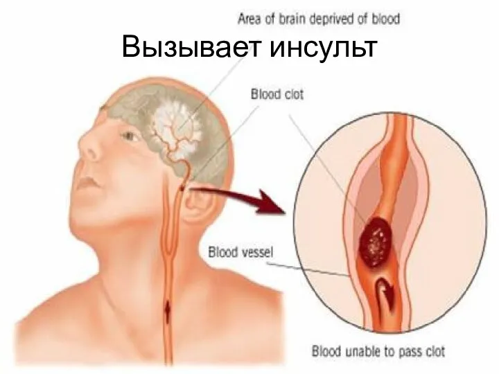 Вызывает инсульт