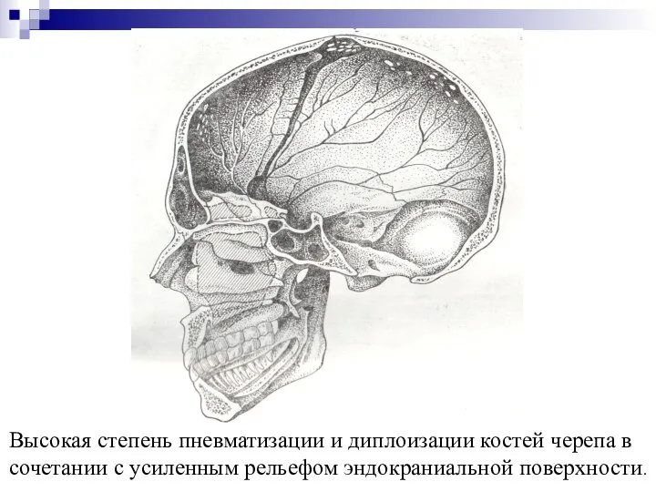 Высокая степень пневматизации и диплоизации костей черепа в сочетании с усиленным рельефом эндокраниальной поверхности.