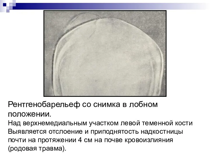 Рентгенобарельеф со снимка в лобном положении. Над верхнемедиальным участком левой теменной кости