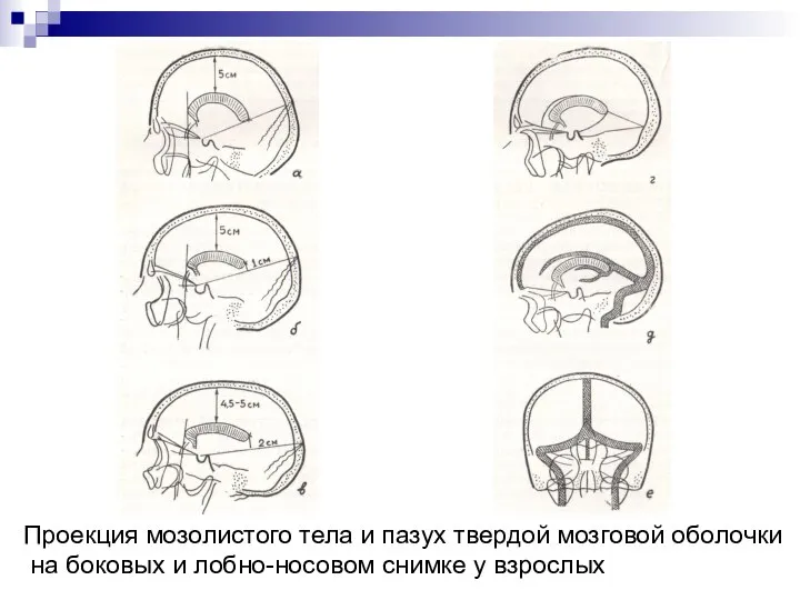 Проекция мозолистого тела и пазух твердой мозговой оболочки на боковых и лобно-носовом снимке у взрослых