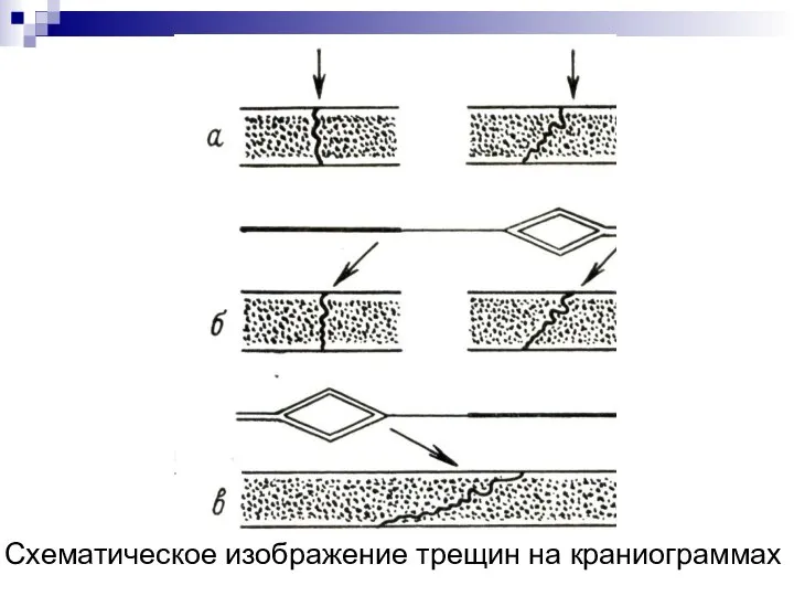 Схематическое изображение трещин на краниограммах