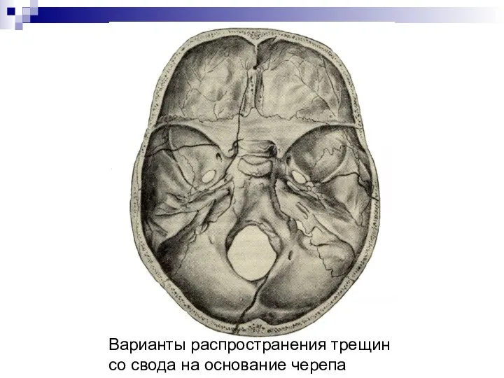 Варианты распространения трещин со свода на основание черепа