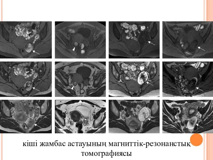 кіші жамбас астауының магниттік-резонанстық томографиясы