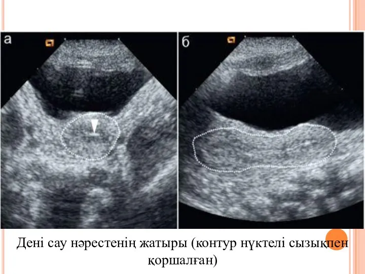 Дені сау нәрестенің жатыры (контур нүктелі сызықпен қоршалған)