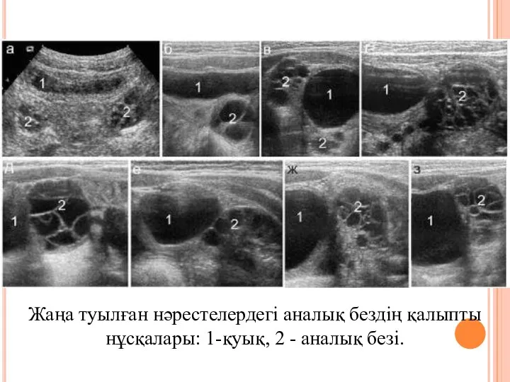 Жаңа туылған нәрестелердегі аналық бездің қалыпты нұсқалары: 1-қуық, 2 - аналық безі.