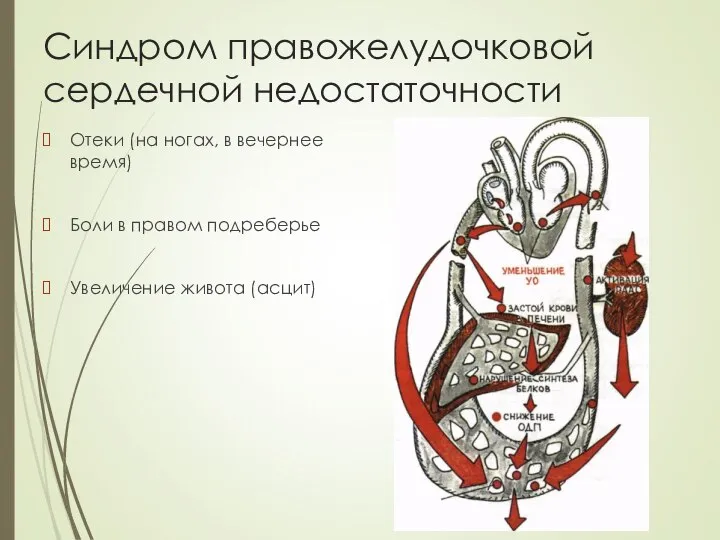 Синдром правожелудочковой сердечной недостаточности Отеки (на ногах, в вечернее время) Боли в