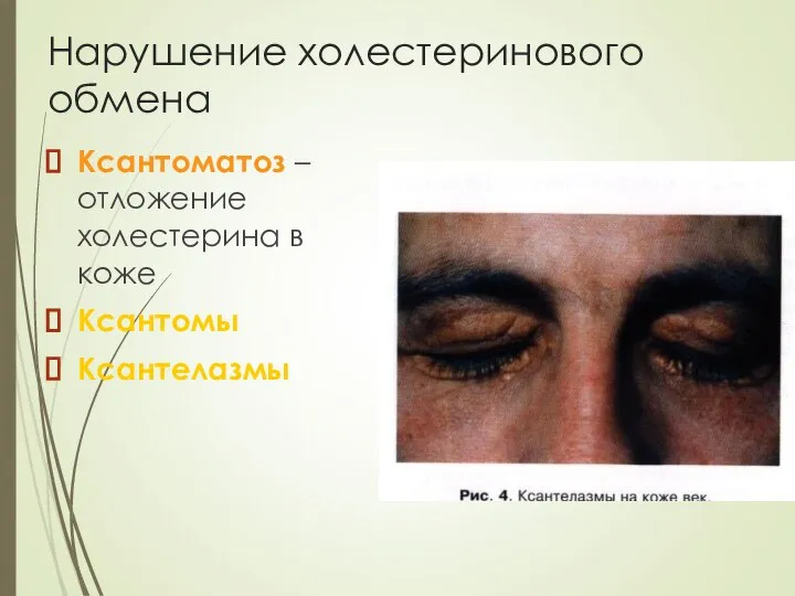 Нарушение холестеринового обмена Ксантоматоз – отложение холестерина в коже Ксантомы Ксантелазмы